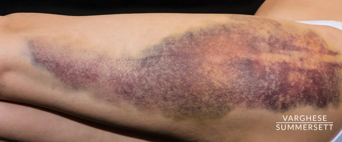 Leg contusion from car accident