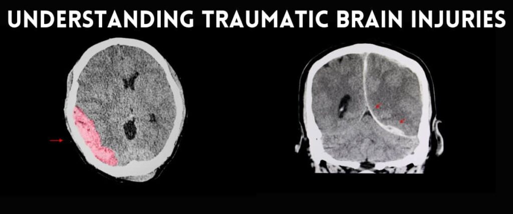 Traumatic Brain Injuries: Legal Options for Recovery